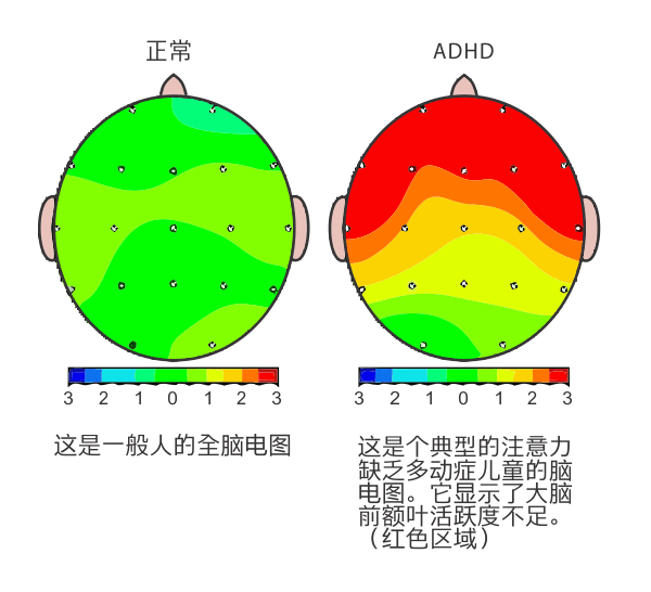多動(dòng)癥.gif